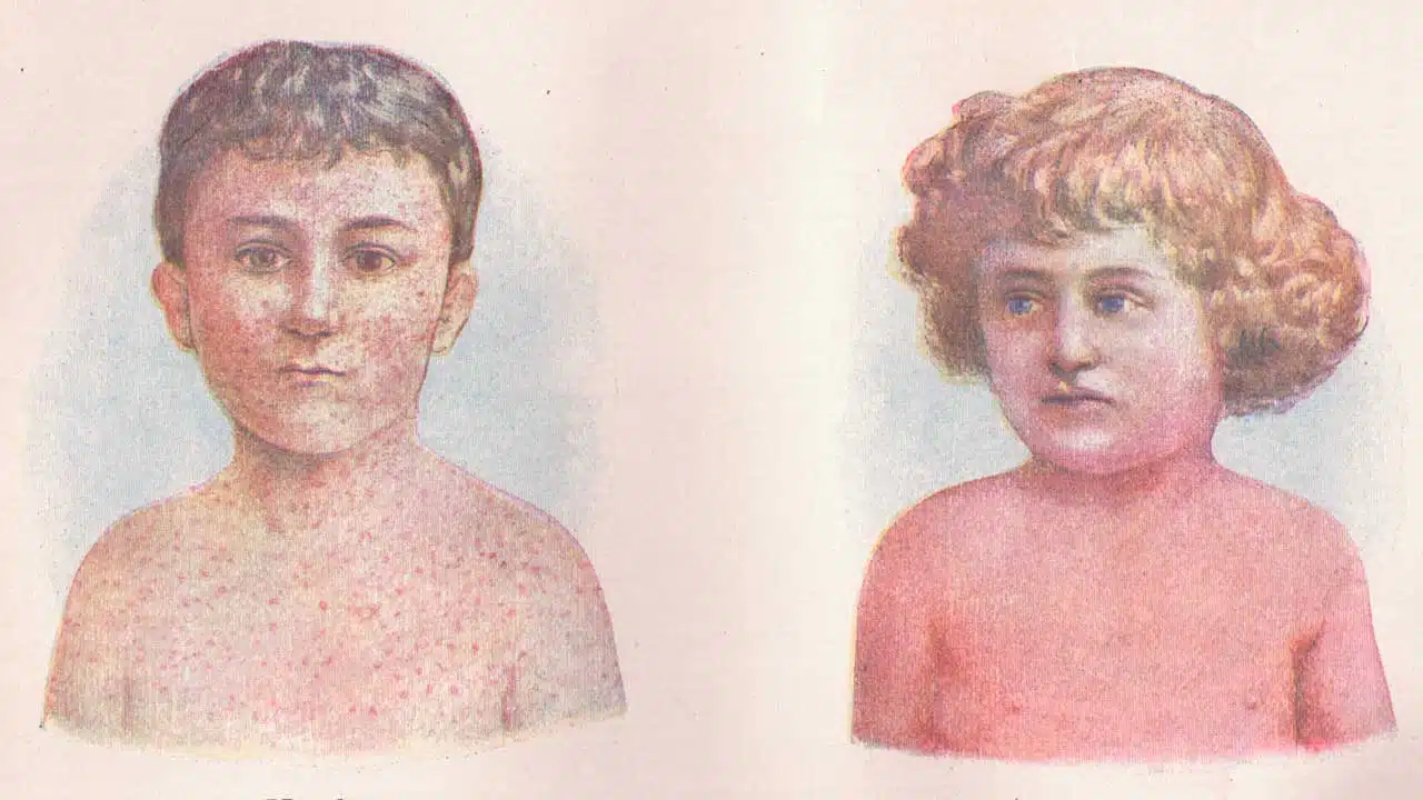 Illustrations of children with measles and scarlet fever (Sue Clark/CC BY 2.0)